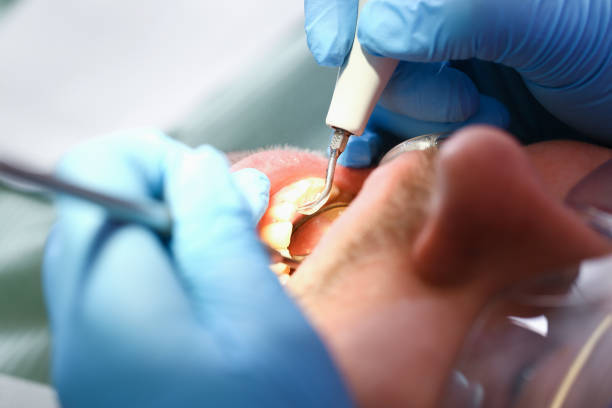 Best Emergency Root Canal Treatment in Lapeer, MI